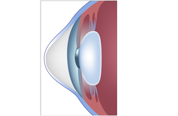 Keratoconus Treatment