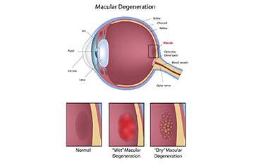 Macular Degeneration