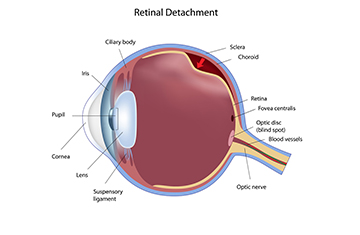Retinal Detachment
